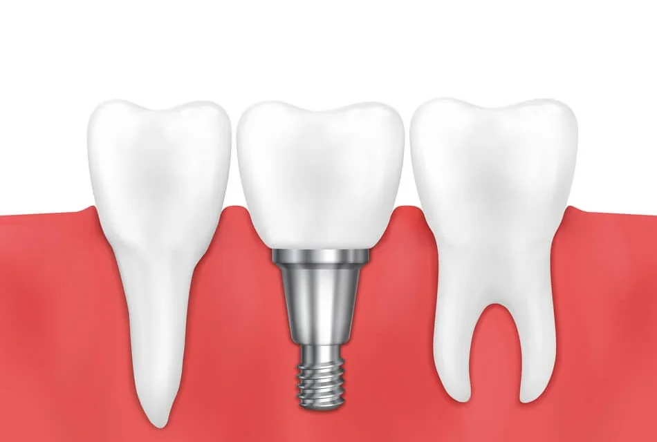 مميزات زراعة الاسنان في الاردن