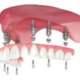 متى لا يمكن عمل زراعة الاسنان
