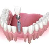 سعر زراعة الأسنان في الأردن