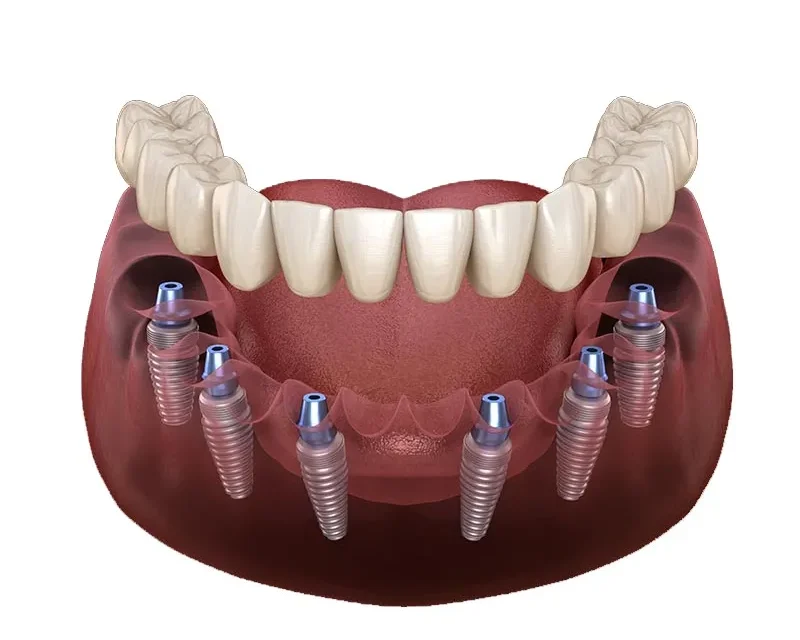 هل زراعة الأسنان مؤلمة